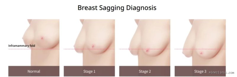 The Gravity of the Situation: At What Age Do Breasts Start Sagging and What Really Triggers Ptosis?