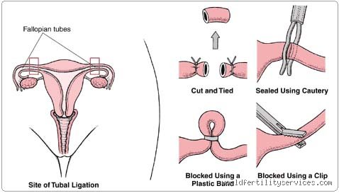 Can I carry a baby if my tubes are tied and what actually happens next?