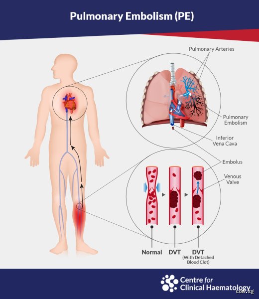 Can You Get a PE Without Having a DVT? The Surprising Truth About Isolated Pulmonary Embolisms