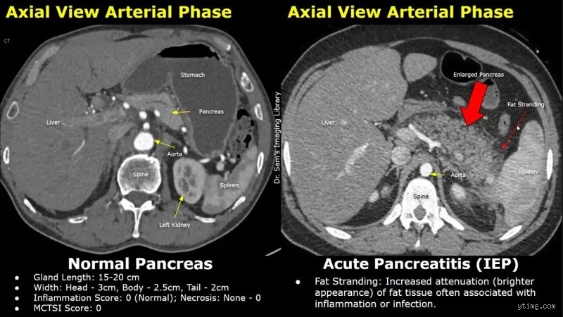 The Hidden Inflammation: Can You Still Have Pancreatitis With a Normal CT Scan?