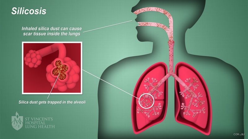 Can your lungs get rid of plastic dust?