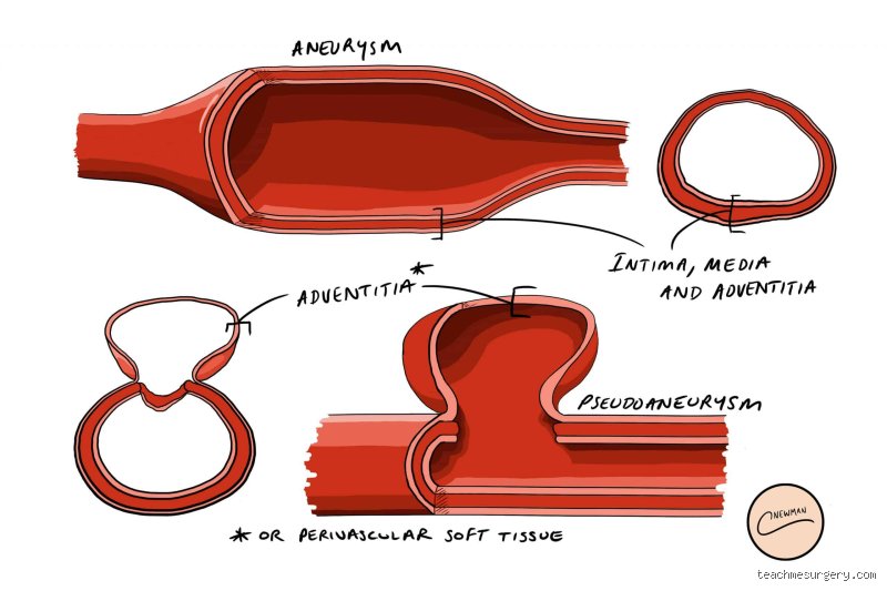 Does Pseudoaneurysm Need Surgery? Unmasking the Ticking Time Bomb Hidden Inside Your Arteries