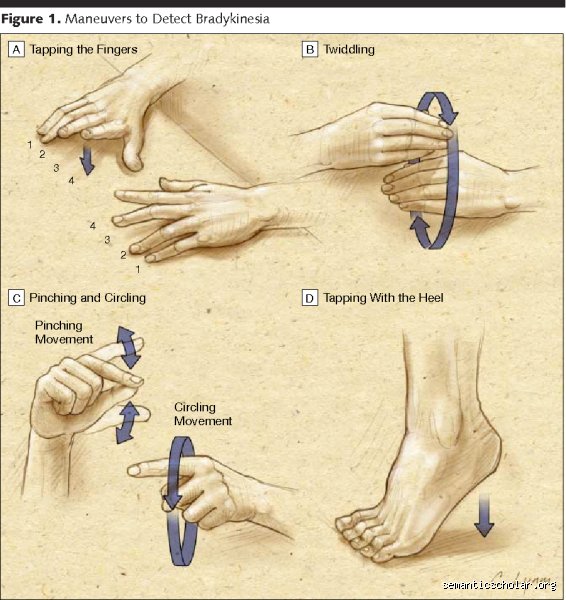 How Can I Test Myself for Parkinson's? The Reality of At-Home Screening and Early Red Flags