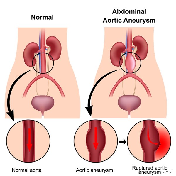How Long Can Someone Have an Aortic Aneurysm Before It Bursts and Changes Everything