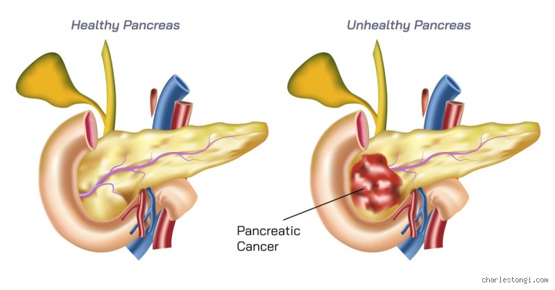 The Reality of Survival: How Long Can You Live with a Bad Pancreatitis Diagnosis?