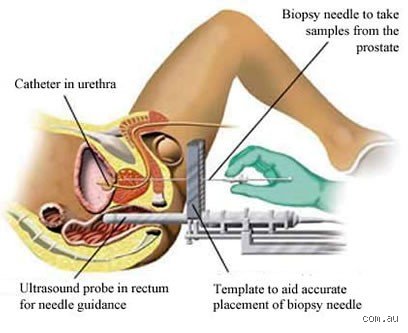 How Long Do I Wait to Go for Walks After a Prostate Biopsy? The Real Recovery Timeline Revealed