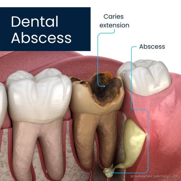 How to get rid of a tooth abscess without going to the dentist and why safety must come first