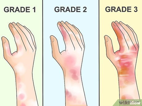 How to Neutralize Acid Burn on Skin Before it Destroys Tissue Permanently