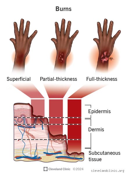 How to Tell if a Burn is Minor or Serious: The Definitive Guide to Identifying Skin Damage and Seeking Medical Intervention