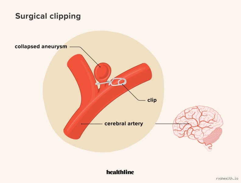 Navigating the Aftermath: What Are the Long-Term Effects of Aneurysm Surgery on Daily Life?