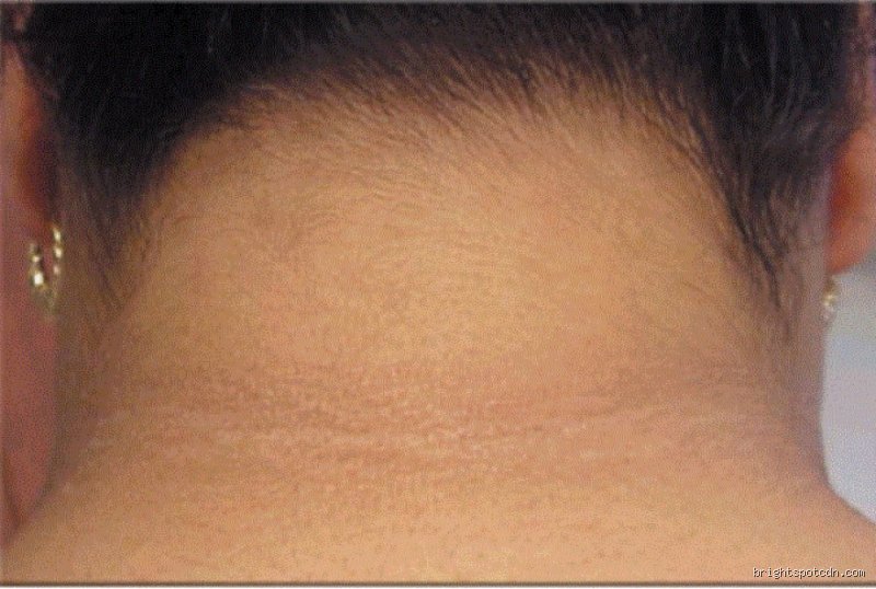 What are the neck signs of diabetes? Unveiling the hidden dermatological warnings you might be missing