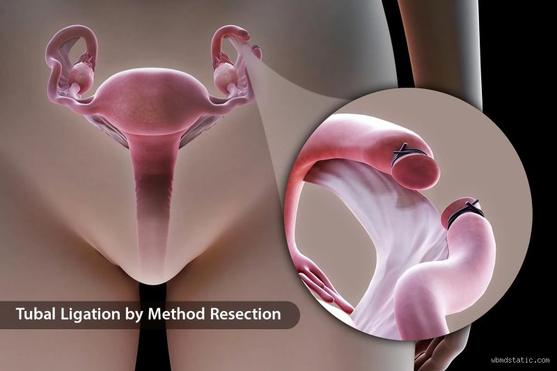 Uncovering the Real Side Effects of Getting Your Tubes Tied Years Later
