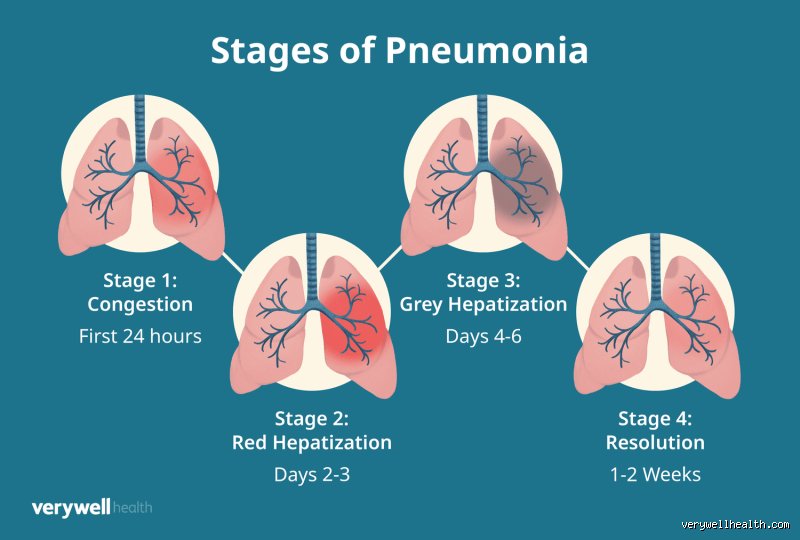 Breathing in the Burn: Unmasking the Earliest Warning Signs and Symptoms of Stage 1 Chemical Pneumonia
