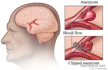 Navigating the Fragile Recovery: What Can You Not Do After an Aneurysm Surgery to Prevent Complications?