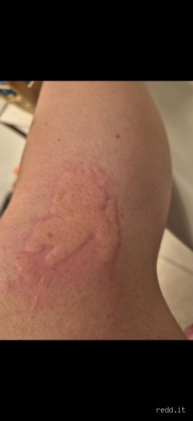 What happens if I leave ice on for too long during injury recovery and physical rehabilitation