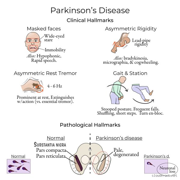 Unmasking MSA: What is the Sister Disease to Parkinson's and Why Does It Elude Diagnosis?