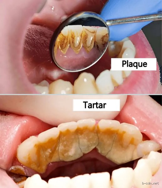 The Grim Reality Behind What Naturally Dissolves Plaque and Tartar Without a Dentist