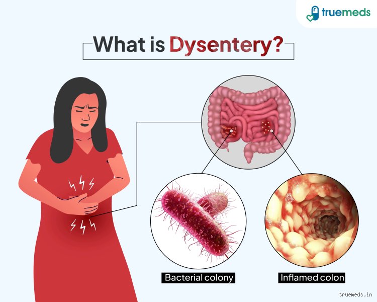 Unmasking the Microscopic Terror: What Organ Does Dysentery Affect Most and Why It Matters Today