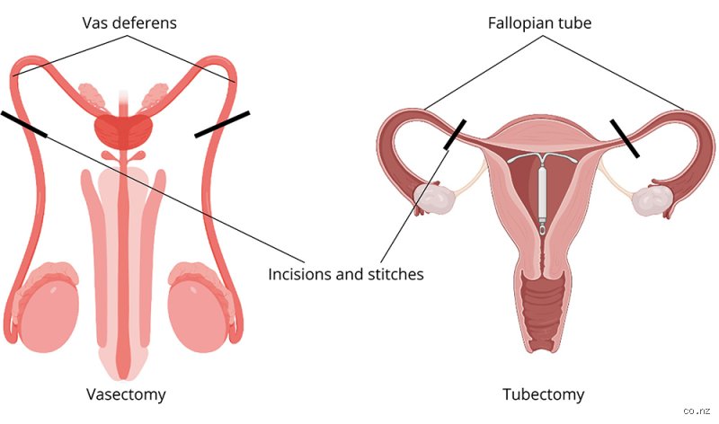 What's riskier, vasectomy or tubal ligation?