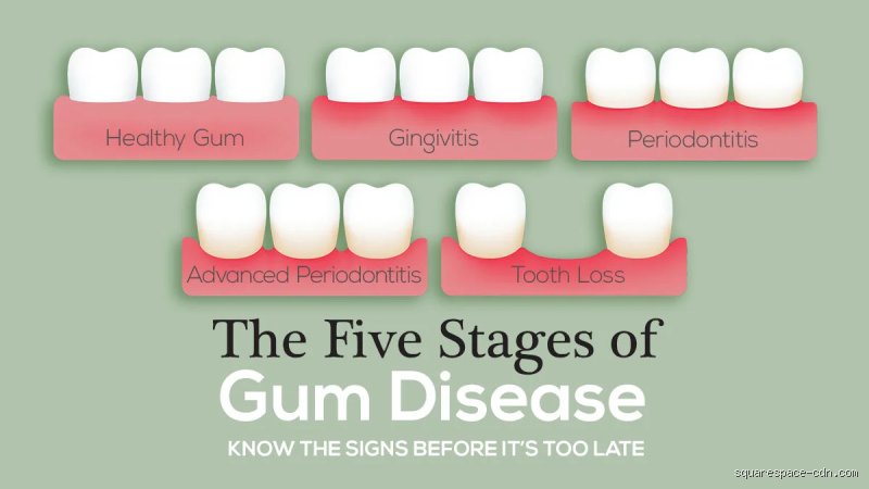 When Is It Too Late to Reverse Gum Disease? The Hidden Threshold Between Healable Tissue and Permanent Bone Loss