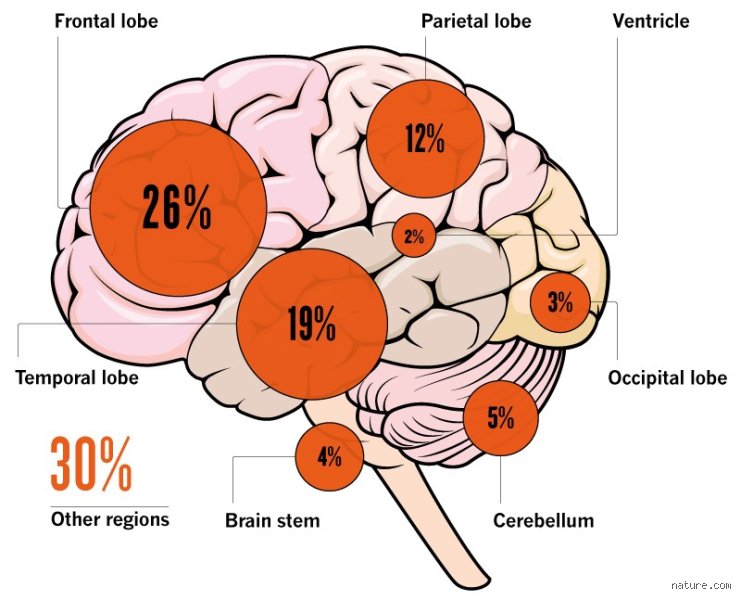 Where Is the Most Common Spot for a Brain Tumor? Unveiling the Anatomy of Cerebral Neoplasms