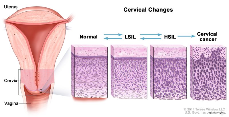 Why Is My Pap Smear Abnormal But No HPV? Understanding The Medical Mystery Behind Your Cervical Screening Results