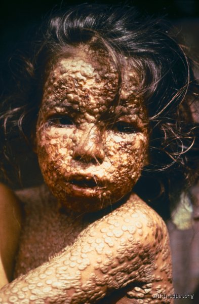 Why Was Smallpox So Fatal? Unraveling the Evolutionary and Immunological Mechanics of Variola (Part 1)