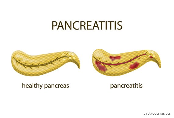 Will pancreatitis go away on its own or does it require immediate medical intervention?