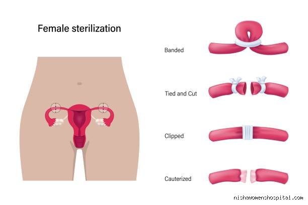Do periods get lighter after tubal ligation or does the surgical reality surprise you?