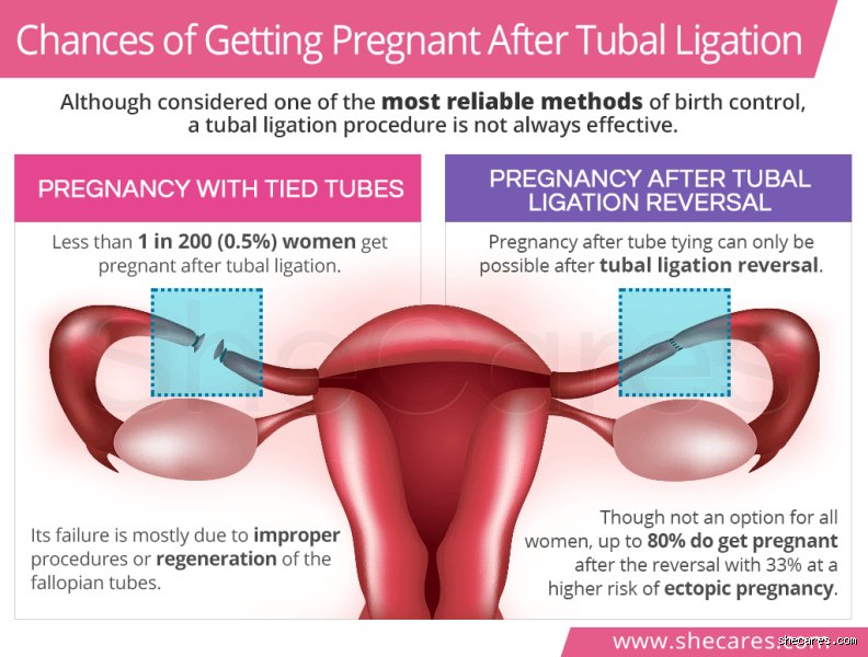 What Are The Chances Of An Older Woman With Her Tubes Tied Getting Pregnant Today