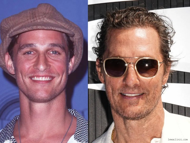 The Anatomy of a Hollywood Smile: Does Matthew McConaughey Wear Dentures? (Part 1)