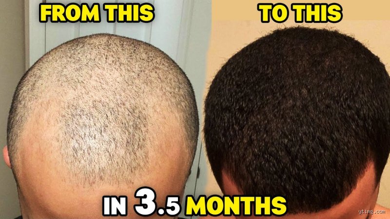 The Ultimate Truth About What Are the Big 3 for Hair Regrowth and Why They Still Rule the Industry