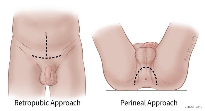 What happens after your prostate is removed and how recovery actually unfolds