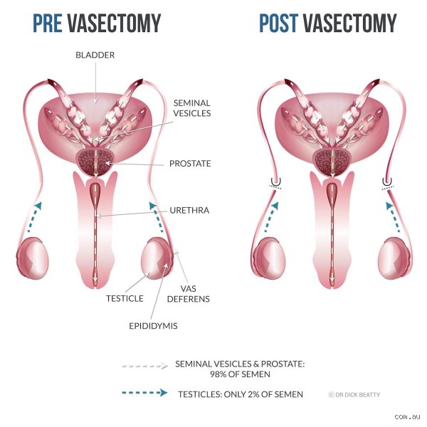 Do vasectomies fail after 20 years?