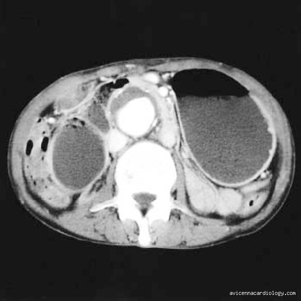 How fast does a 4 cm aortic aneurysm grow?