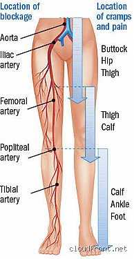 Is Walking Good for Blocked Arteries in the Legs?