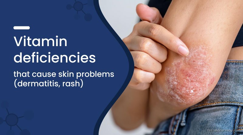 Scratching the Surface: What Deficiency Causes Skin Itching and Why Your Nutrition is to Blame