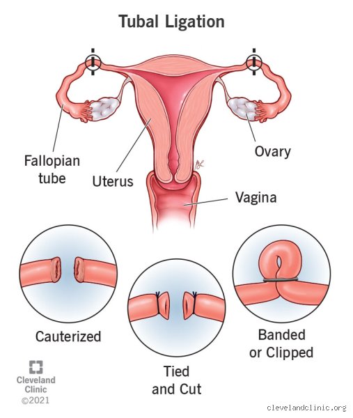 Cutting the Cord: What Happens When a Woman Gets Sterilized and the Truth About Permanent Birth Control