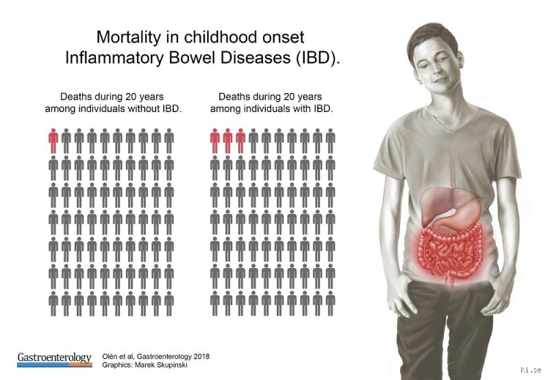 What Is the Life Expectancy of Someone with Crohn's Disease and How Modern Treatments Shape Survival Rates