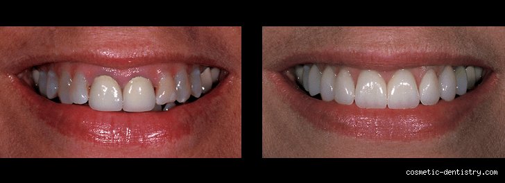 The Hidden Risk of Brightness: Does Hydrogen Peroxide Damage Dental Crowns and Porcelain Work?