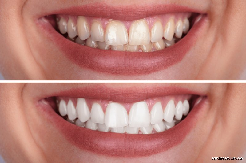 Mastering 22% Carbamide Peroxide: The Definitive Guide to Wear Times, Chemistry, and Safe Application (Part 1)