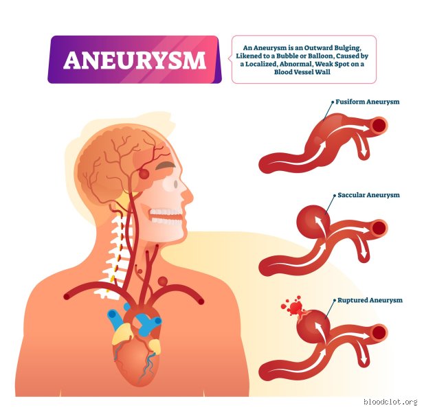 The Fragile Pipeline: Does a Blood Thinner Help Aneurysms or Trigger a Catastrophe?