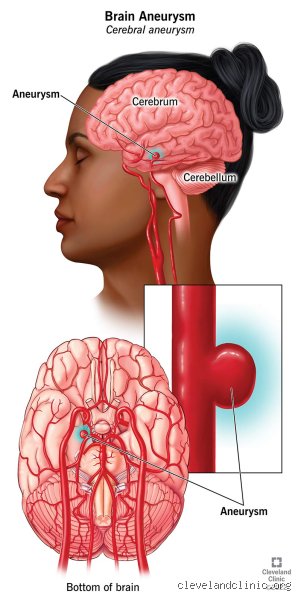 Living on a Fault Line: How Long Can You Live with an Unruptured Aneurysm Safely?