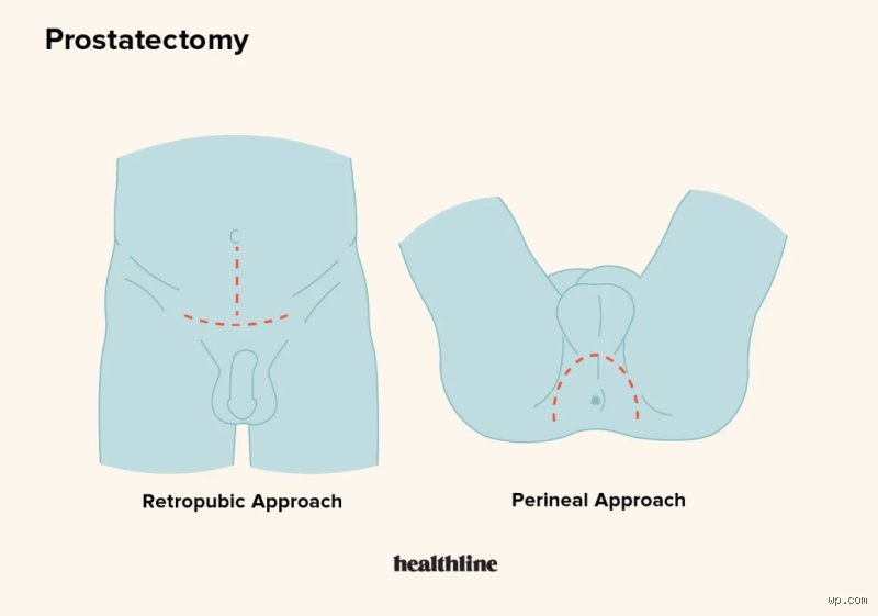 The Clock in the OR: How Many Hours Is Prostate Surgery When Facing Radical Treatment?