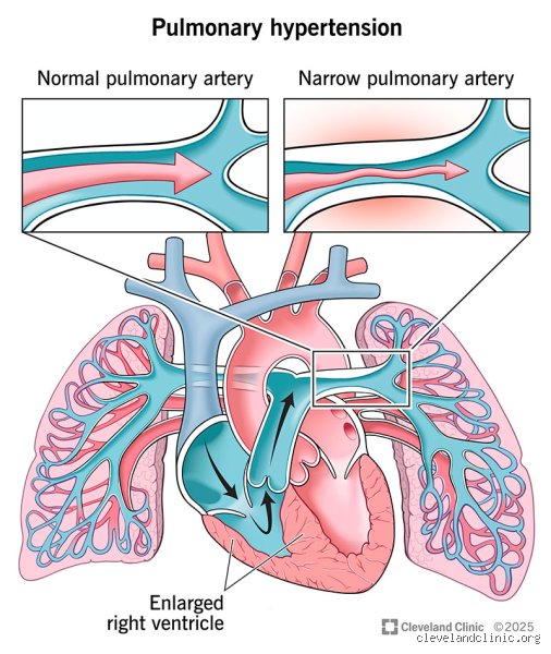 Is PAH Always Fatal? Unraveling the Modern Reality of Pulmonary Arterial Hypertension