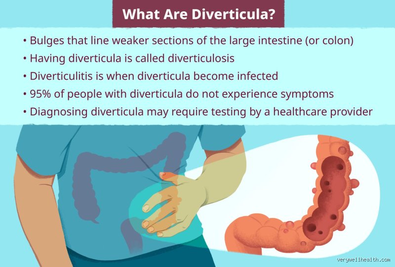 The Unforgiving Spark in Your Gut: What Does Diverticulitis Pain Feel Like, and Why Is It So Widely Misunderstood?
