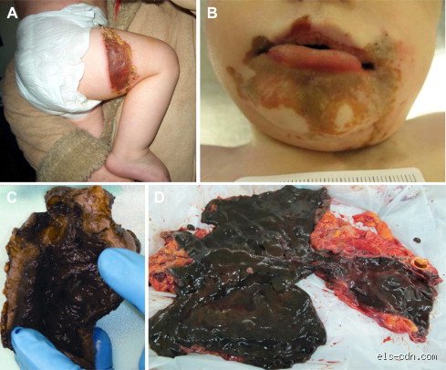 What Happens If a Human Touches Sulfuric Acid? The Terrifying Chemistry of Extreme Skin Burns