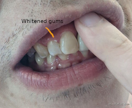 The Cost of a Bleached Smile: What Happens If You Use Too Much Hydrogen Peroxide on Teeth?