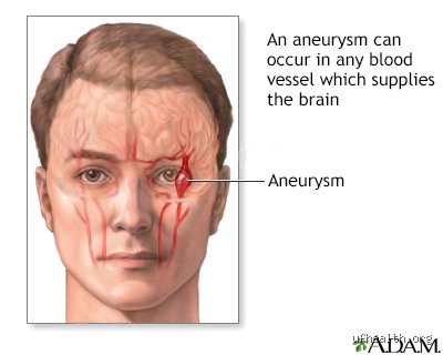 What happens to your eyes when you have a brain aneurysm? The hidden visual warning signs you cannot afford to ignore