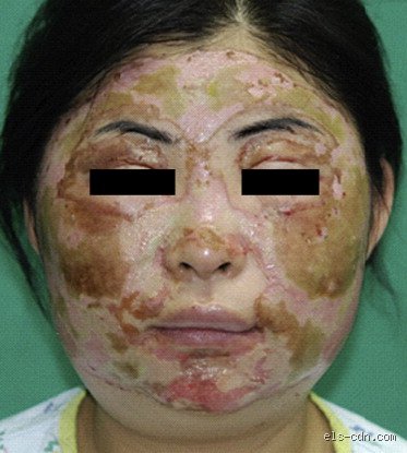 What Happens When Acetic Acid is Touched? Skin Contact Risks, Chemical Burns, and the Science of Tissue Damage